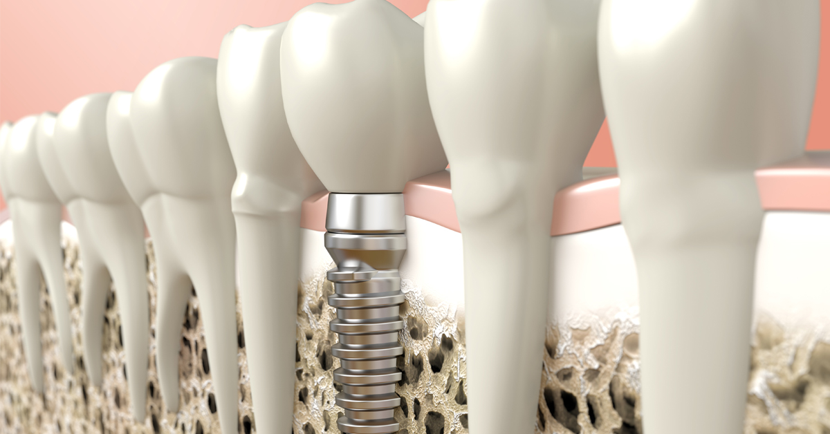 implant de dinte